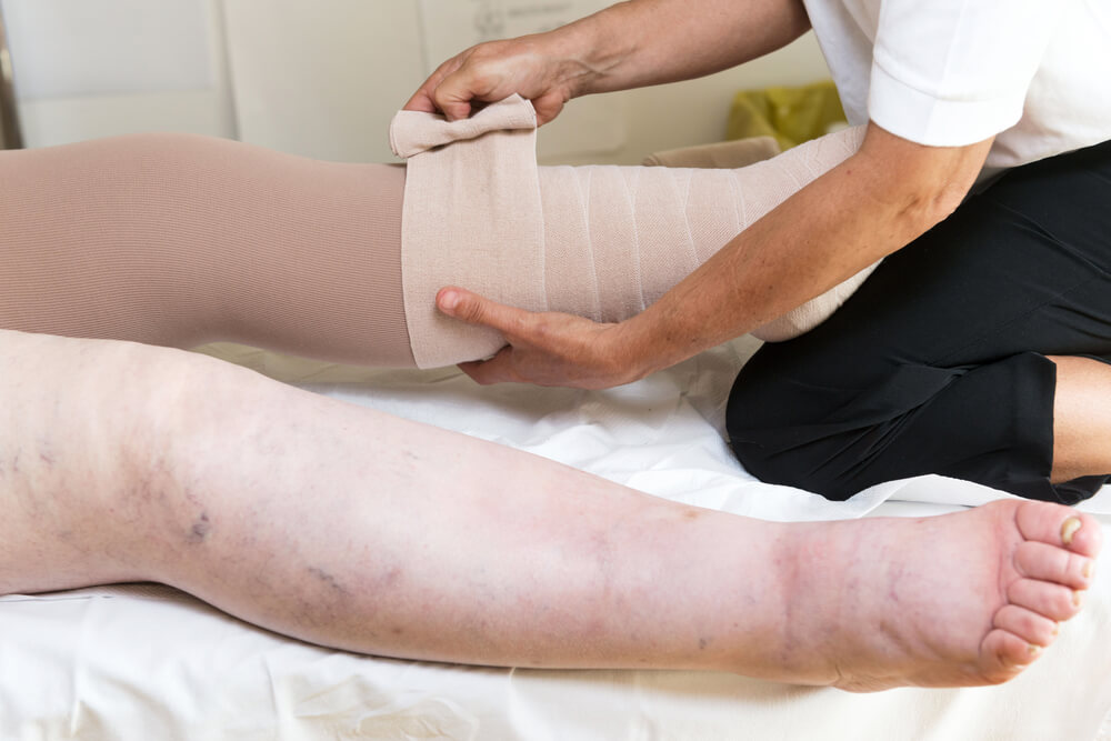 Understanding how lymphedema therapy can help your quality of life