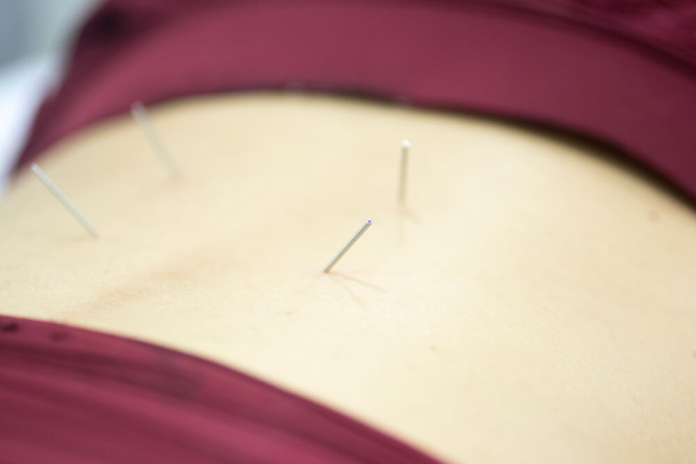 Dry Needling for Sciatica